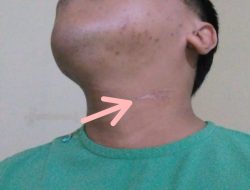 Tali Layangan di Jalanan Makan Korban, Warga Sumber Jeruk Jambesari Alami Luka -luka